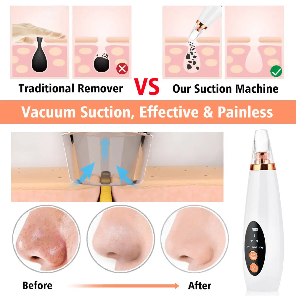 Electric Blackhead Removing Device - Vior Paris